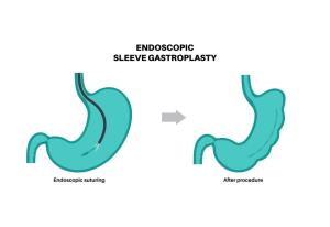 Exploring New Technologies in Endoscopic Sleeve Gastroplasty