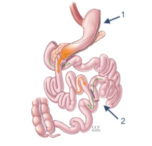 How Biliopancreatic Diversion with Duodenal Switch Surgery Affects Diabetes Management