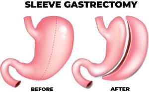 How Sleeve Gastrectomy Helps in Controlling Hunger Hormones