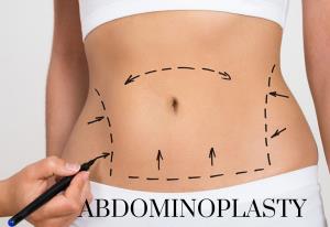 Diagnosing Conditions That Might Need a Tummy Tuck