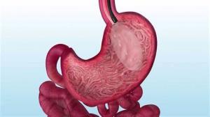 Long-Term Effects of Intragastric Balloon on Digestive Health