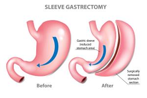 The Role of Endoscopy in Sleeve Gastrectomy Surgery