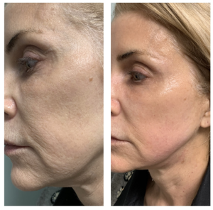 How Facelift Surgery Enhances Anti-Aging Treatments