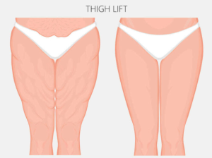 Recognizing the Signs for Thigh Lift Surgery