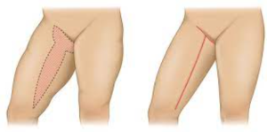 Effective Strategies to Manage Pain After Thigh Lift Surgery