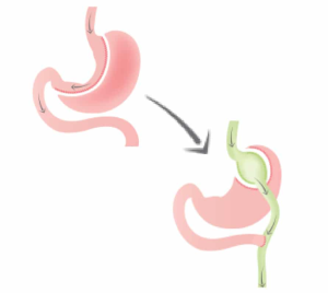 Signs You May Need Revision Bariatric Surgery