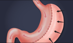 Understanding the Success Rates of Revision Bariatric Surgery