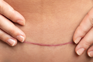 Effective Strategies for Managing Tummy Tuck Scars