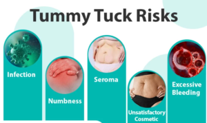 Understanding the Risks and Complications of Tummy Tuck Surgery