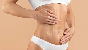 Understanding Muscle Repair in Tummy Tuck Surgery