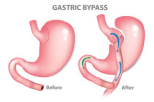 Is Mini Gastric Bypass Surgery the Right Choice for You?