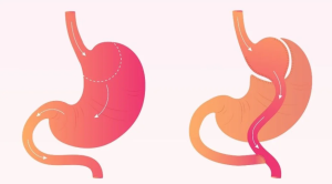 What to Expect During Recovery from Mini Gastric Bypass Surgery