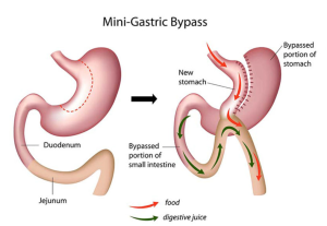 Understanding the Success Rates of Mini Gastric Bypass Surgery in India