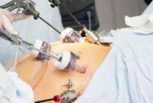 Understanding the Costs of Mini Gastric Bypass Surgery in India