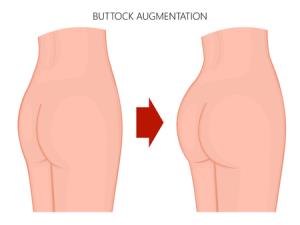 Buttock Augmentation in India