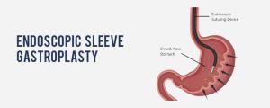 Endoscopic Sleeve Gastroplasty (ESG) in India