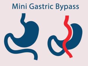 Mini Gastric Bypass Surgery in India