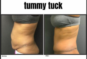 Tummy Tuck Surgery in India