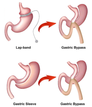 Revision Bariatric Surgery in India