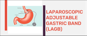 Laparoscopic Adjustable Gastric Banding (LAGB) Surgery in India