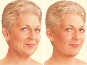 Facelift Surgery in India