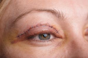 Eyelid Surgery in India