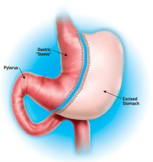 Sleeve Gastrectomy Surgery in India