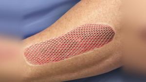 Skin Grafts for Burn Treatment in India