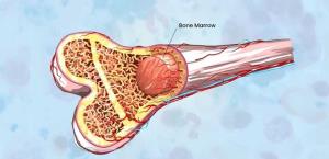 The Role of Chemotherapy in Bone Marrow Transplant Preparation