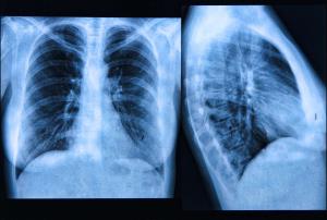 The Role of Lung Transplant in Cystic Fibrosis Management