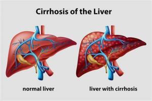 Understanding Liver Cirrhosis and Its Link to Liver Transplant