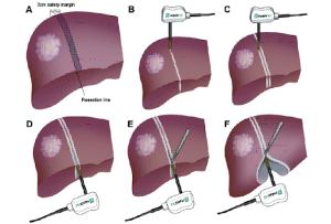 Key Differences Between Liver Transplant and Liver Resection Surgery