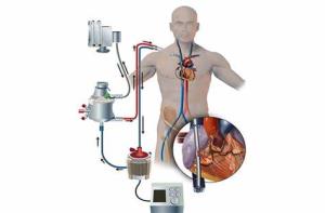 Role of Artificial Hearts as a Bridge to Transplant