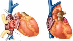 The Role of Heart Transplantation in Treating Severe Cardiomyopathy