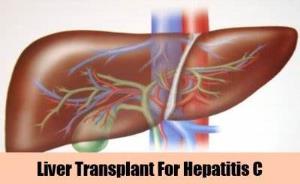 The Importance of Liver Transplant in Treating Hepatitis C