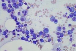 Bone Marrow Transplants for Lymphoma A Complete Overview