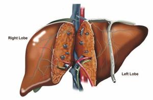 Benefits of Living-Donor Liver Transplant vs. Deceased Donor