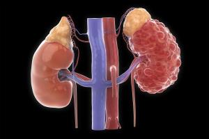 The Role of Kidney Transplant in the Treatment of Polycystic Kidney Disease