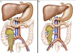 Understanding When a Pancreas Transplant Becomes Necessary