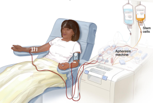 How Stem Cells Contribute to Bone Marrow Transplant Success