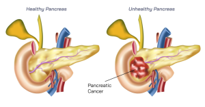 Understanding the Role of Pancreas Transplants in Managing Chronic Pancreatitis