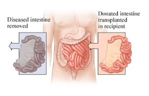 Intestine Transplant in India