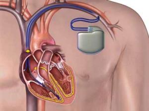 Symptoms Indicating the Need for AICD Surgery