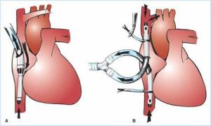 Latest Innovations in Heart Bypass Surgery Techniques