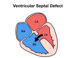 Causes and Symptoms of Ventricular Septal Defect