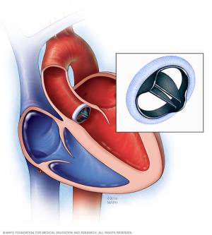 Risks and Complications Associated with Heart Valve Surgery