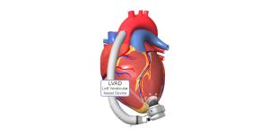 How to Manage Heart Failure Before and After Left Ventricular Assist Device Surgery