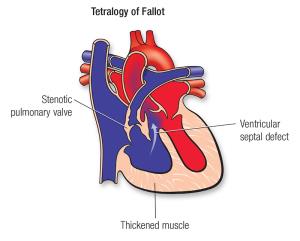 Risks and Complications of Tetralogy of Fallot Surgery