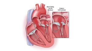 Key Symptoms Indicating You Might Need Mitral Valve Replacement