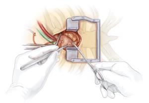 Innovations in Heart Valve Surgery Minimally Invasive Techniques